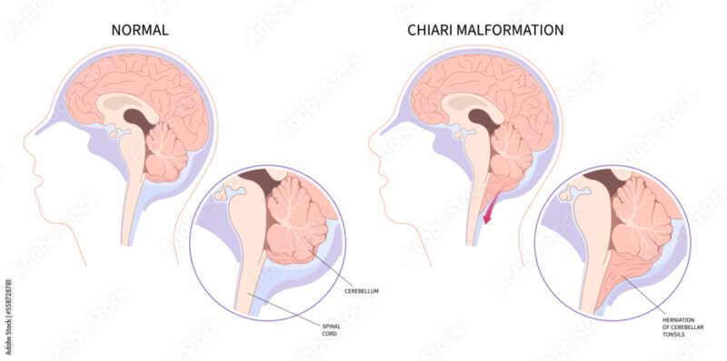 chiari